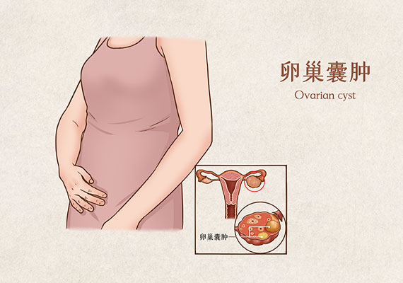 卵巢囊肿