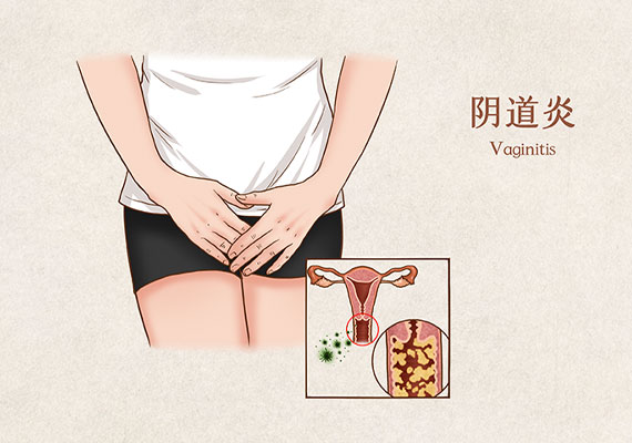 阴道炎