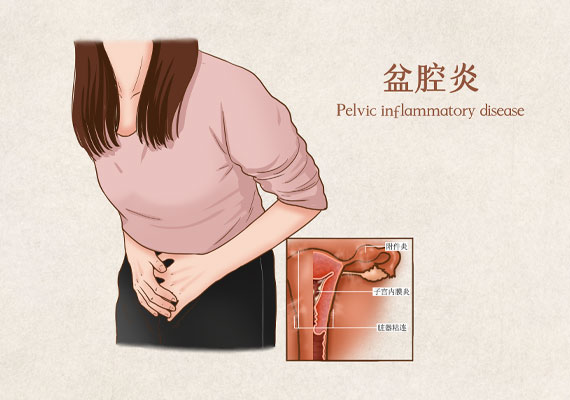 盆腔炎