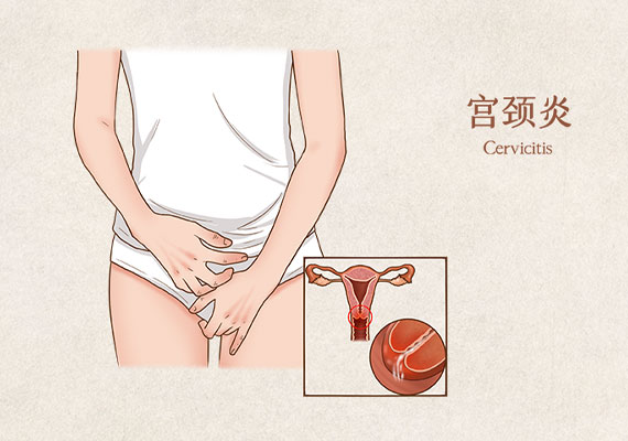宫颈炎